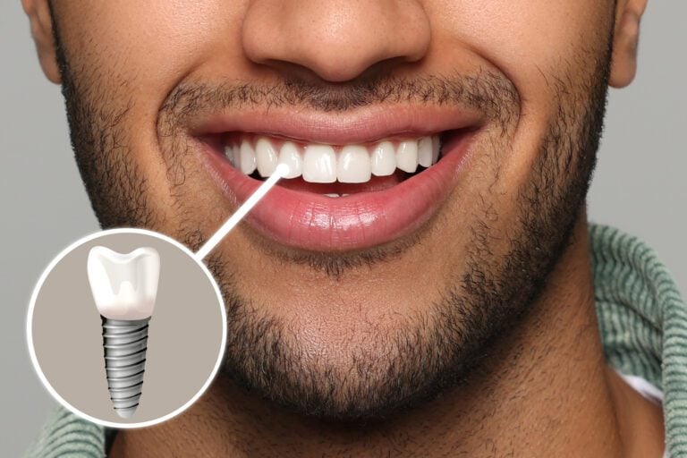 dental crown dental emergency wichita ks dental implants