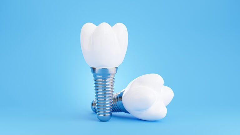 Wichita tooth replacement option Dental Implants in Wichita